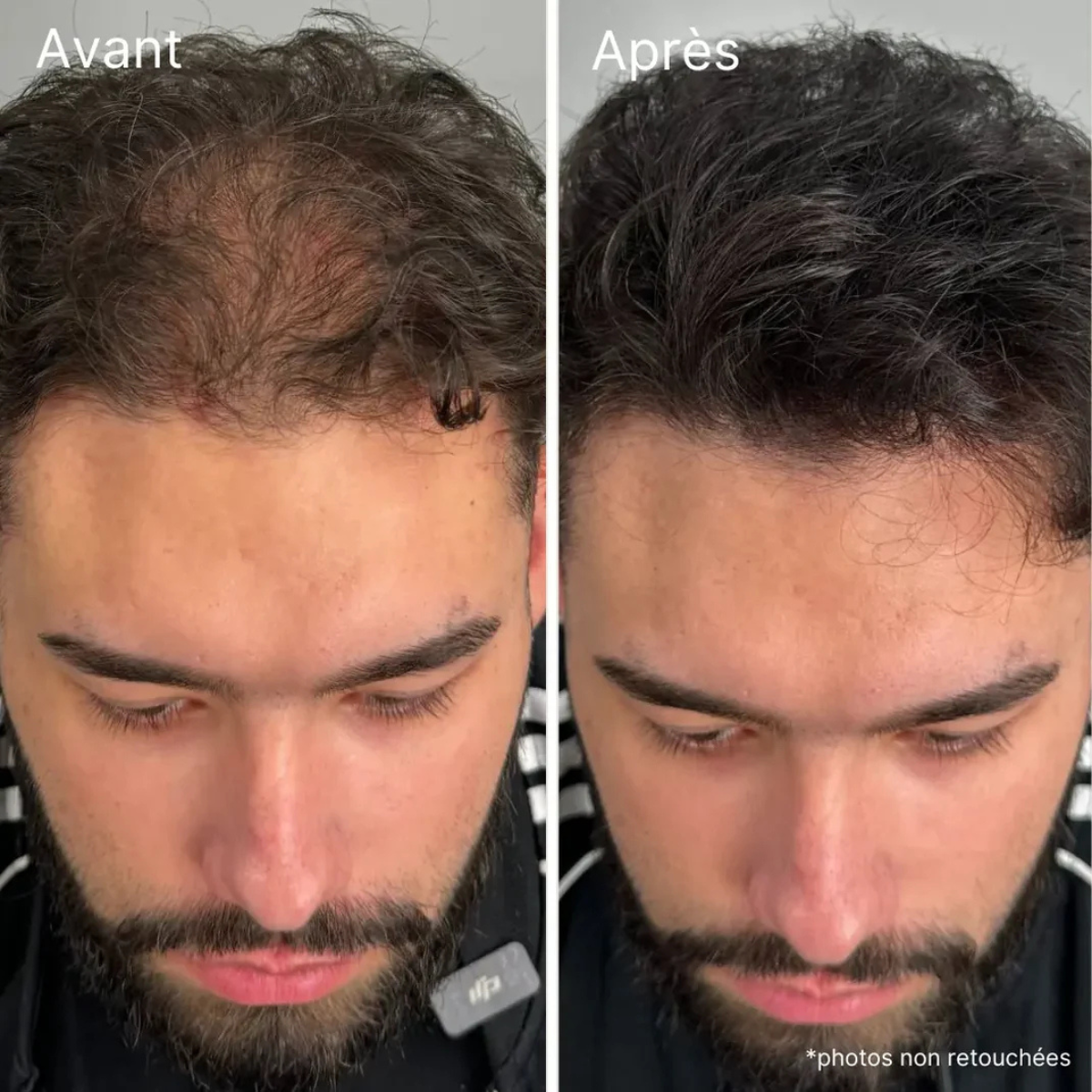 Crème capillaire PalmHair® - Effet densité immédiat